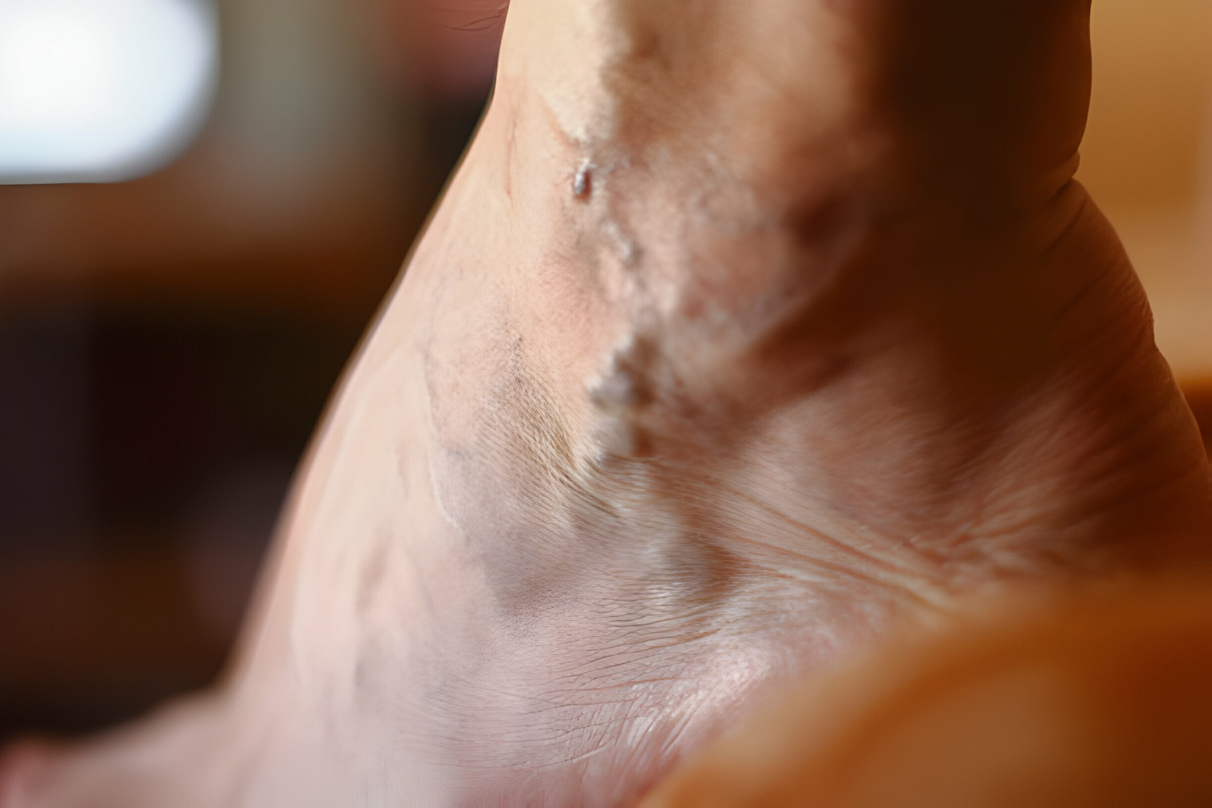 ABOUT SCLEROTHERAPY