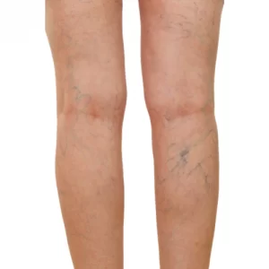 Sclerotherapy-Treatment-in-Dubai-1