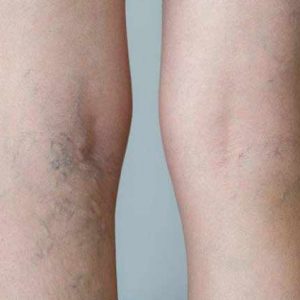 SpiderVein-Treatment-