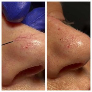 vein-treatment-nose-1024x1024